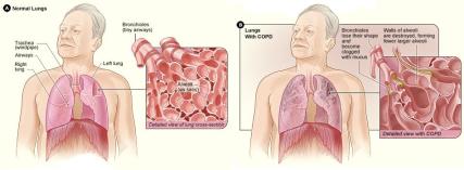 Steroids pulmonary oedema